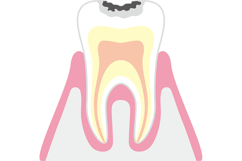 初期むし歯（C1）