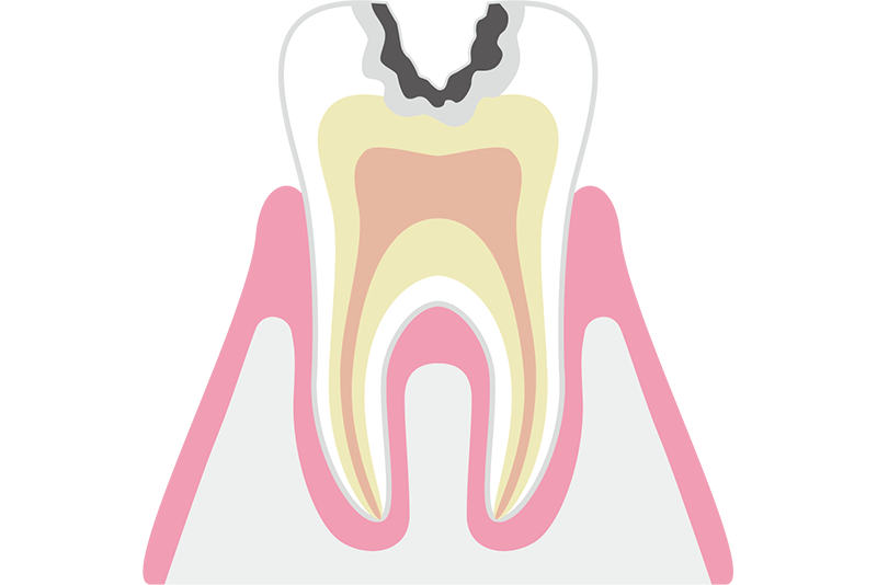 象牙質まで進行したむし歯（C2）