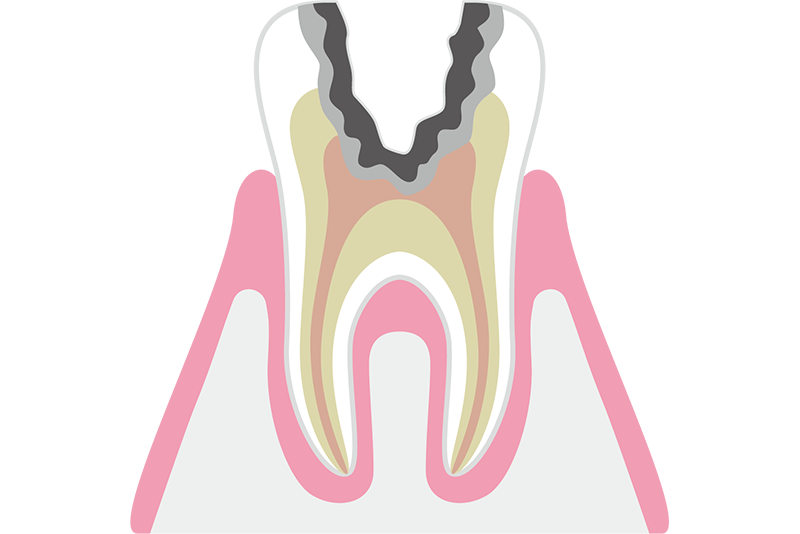 神経まで進行したむし歯（C3）