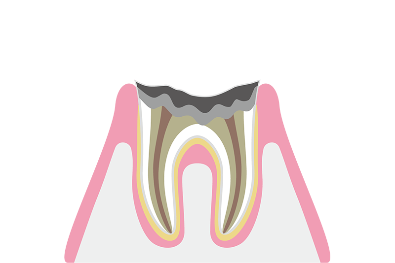 歯根だけ残ったむし歯（C4）